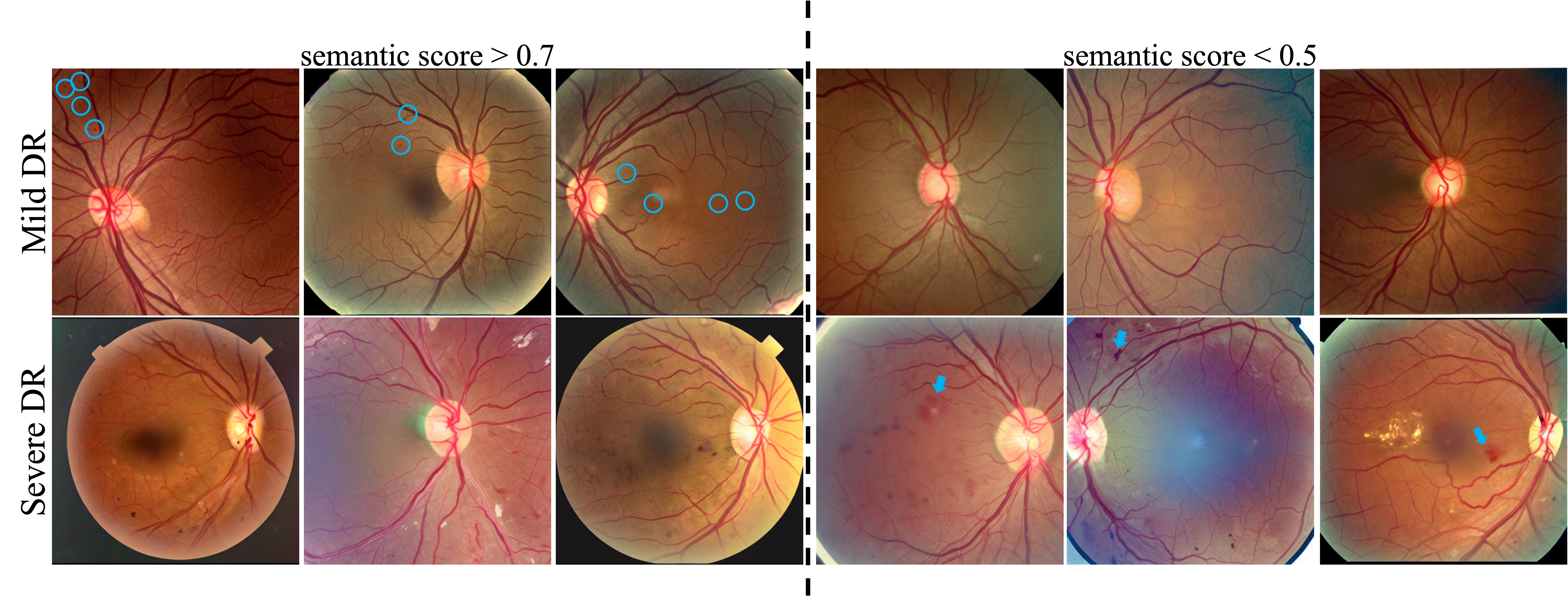 In the first row, the samples on the left achieve a higher semantic score and display microaneurysms—key diagnostic features of mild DR. In contrast, the samples on the right either lack visible microaneurysms or suffer from poor image quality. In the second row, the left-side samples demonstrate characteristic features of severe nonproliferative DR, including diffuse retinal hemorrhages, microaneurysms across all four quadrants, and venous beading in at least two quadrants. In comparison, the right-side samples are more indicative of proliferative DR, as they show signs of neovascularization with intra- or subretinal hemorrhage.